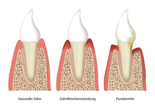 Schaubild: Querschnitt eines gesunden Zahns im Vergleich mit Zahnfleischentzündung und Parodontitis