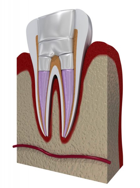 Querschnitt eines Zahns mit Wurzelkanalfüllung
